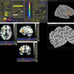 In a video, Aron Barbey discusses his work linking specific brain injuries, seen here in a brain scan, to impairment on particular cognitive functions.