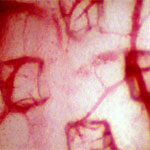 After the stamp is removed its pattern is revealed in the pattern of blood vessels below.