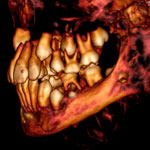 Images from the recent CT scans of the mummy show that the child still had some of its baby teeth, with adult teeth coming in.