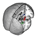 MRI scans reveal the brain structures analyzed in this study: nucleus accumbens (orange), putamen (red), caudate nucleus (blue), and hippocampus (green).