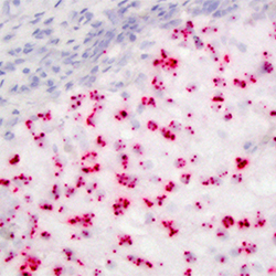 Labeled cancer tissue from a California sea lion showing positive pink signaling for the otarine herpesvirus-1 BCL-2 oncogene within the tumor.