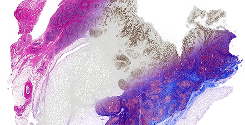 Breast tissue is computationally stained using data from infrared imaging without actually staining the tissue, enabling multiple stains on the same sample. From left, the image shows a Hematoxylin and Eosin stain (pink-blue), molecular staining for epithelial cells (brown color) and Masson's trichrome(blue, red at right).