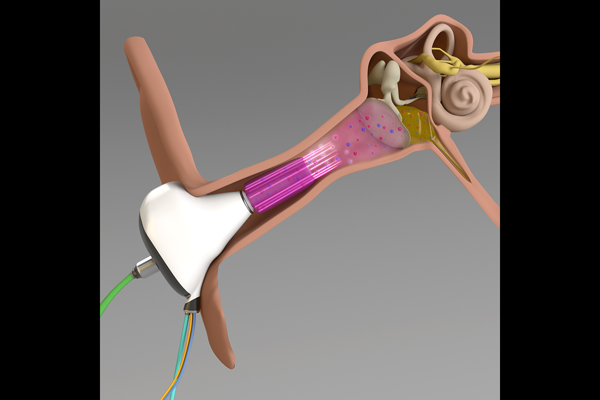 Image of a medical device in the outer ear. The device is streaming microplasma towards the eardrum and middle ear.