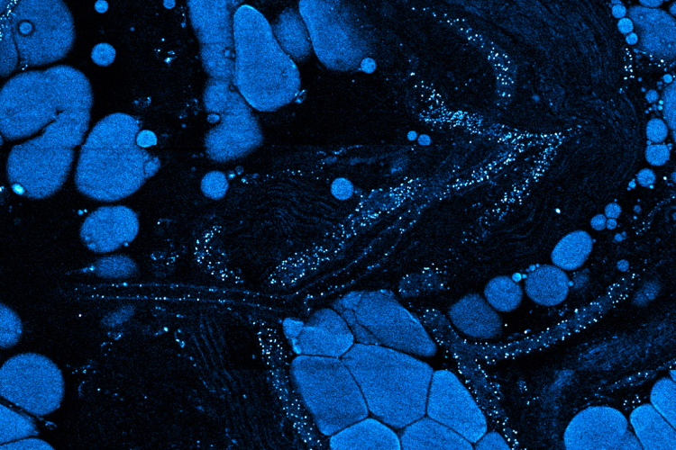 A constellation of vesicles, tiny cellular transport packages seen here as blue dots, are released by cancer cells into the surrounding tissue. Illinois researchers found that these vesicles, coupled with molecular changes in metabolism, can signal big changes in the tissue around tumors.