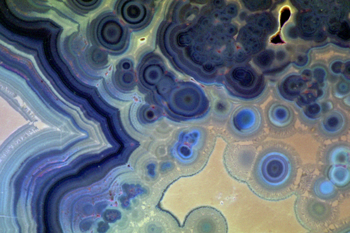 A microscope image of round microspherules beginning to coalesce on the surface of a forming kidney stone.